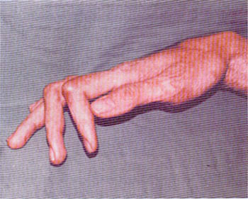 Fig. (1-A): Post-burn stiff PIP of the right index and middle fingers of 18 years old male patient (case-1).