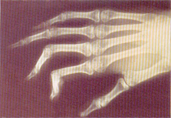 Fig. (1-B): Pre-operative X-ray showing stiff joints.