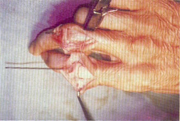Fig. (1-C): Intra-operative view showing good bony contact using a cup-and-cone technique fixed by a combination of K-wire and wire loop. 