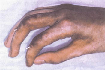 Fig. (1-E): Early post-operative view.