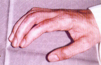 Fig. (1-F): Late post-operative view.