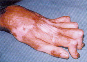 Fig. (2-A): Post-burn stiff PIPJ of the left index, middle, ring and little fingers of 9 years old female patient (case-2)