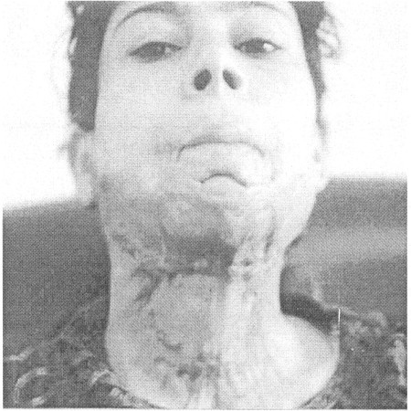 Fig. (1-A)Preoperative picture of post-burn keloid of the young lady affecting the whole lower third of her face.
