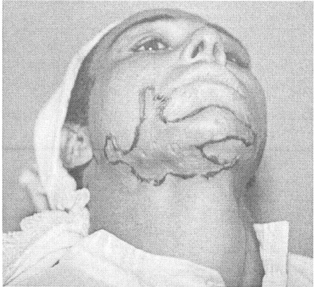 Fig. (2-B)Early postoperative view after 20 days.