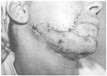 Fig. (1-B)Late post-operative picture after one piece full thickness grafting of the lower third. One year postoperative view.