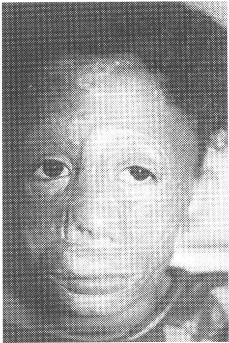 Fig. (3-A)Preoperative view of post burn complication of 75% of the face.