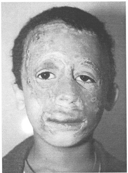 Fig. (3-B)Postoperative view after full thickness one sheet resurfacing (2 months postoperative).