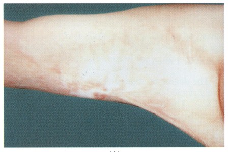 Fig (1) A Z-Plasty A