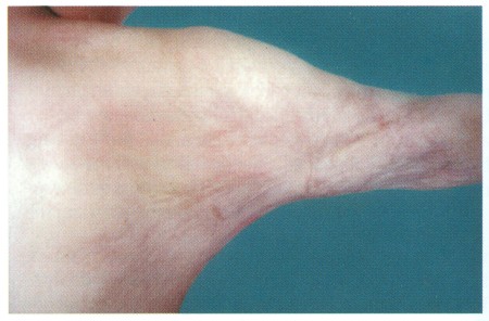 Fig (1) B Z-Plasty A