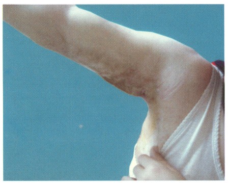 Fig (1) C Z-Plasty A