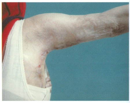 Fig (1) D Z-Plasty A