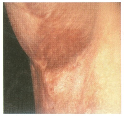 Fig (2) A Z-Plasty A