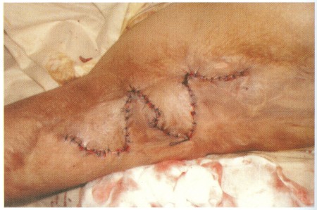Fig (2) B Z-Plasty A