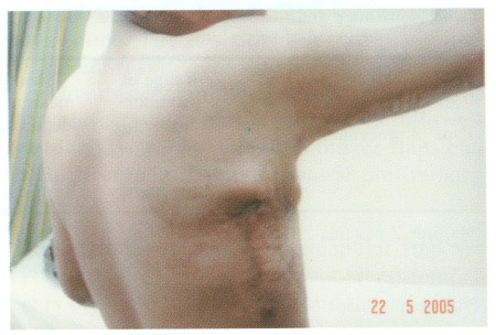 Fig (3) B Parascapular flap
