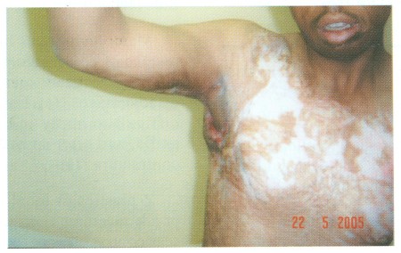 Fig (3) C Parascapular flap