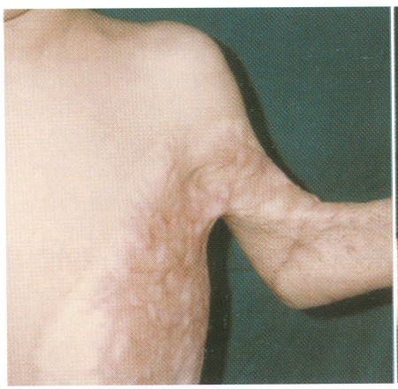 Fig (5) A Parascapular flap