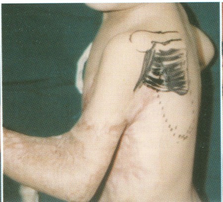 Fig (5) B Parascapular flap