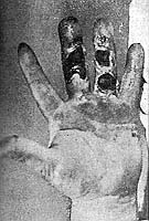 Figura 1 Fotografía de la mano quemada a los diez días del accidente (cara palmar)
