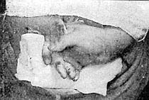 Figura 6 Colgajo de Dlefenbach.Se ha seccionado el pedículo inferior.