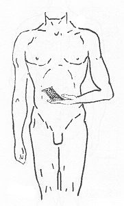 Figura 7 Colgajo abdominal monopediculado plano. Método italiano.